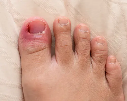 How Foot Fungus Affects Athletes and What to Do About It