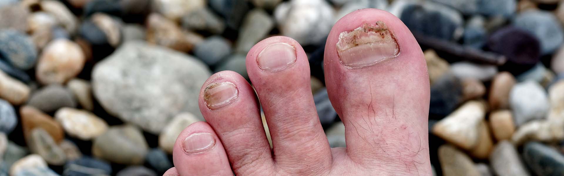 How to Prevent Ingrown Toenails with Proper Foot Hygiene