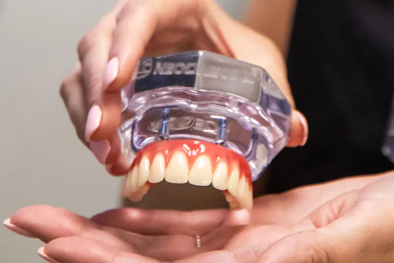 What You Need to Know About the Long-Term Benefits of Dental Implants