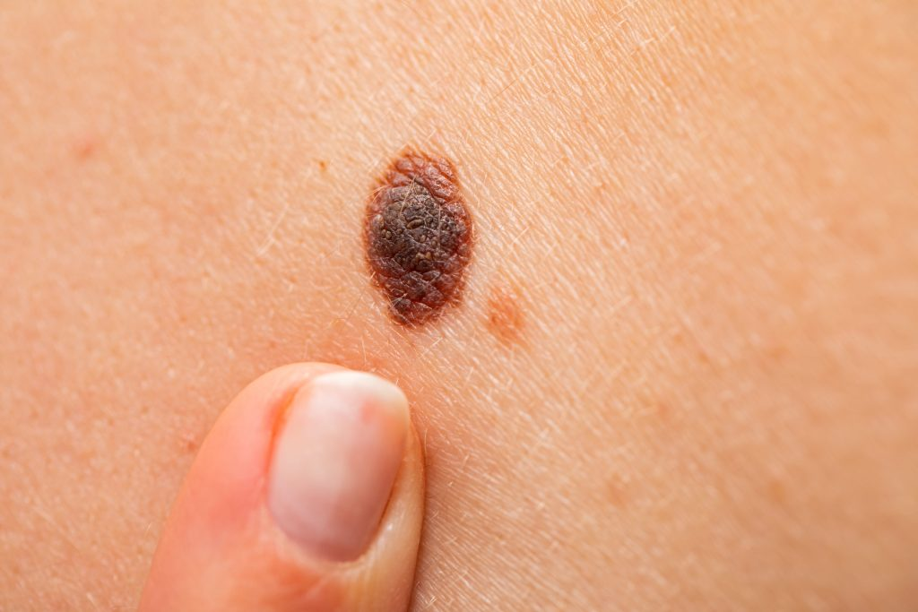 Difference Between Melanoma and Other Skin Cancers