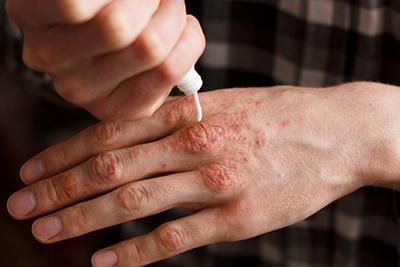 How to Treat Eczema Flare-Ups Naturally