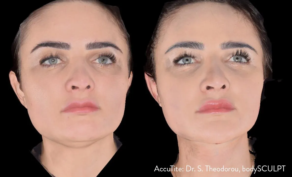 Brow Lift vs. Facelift