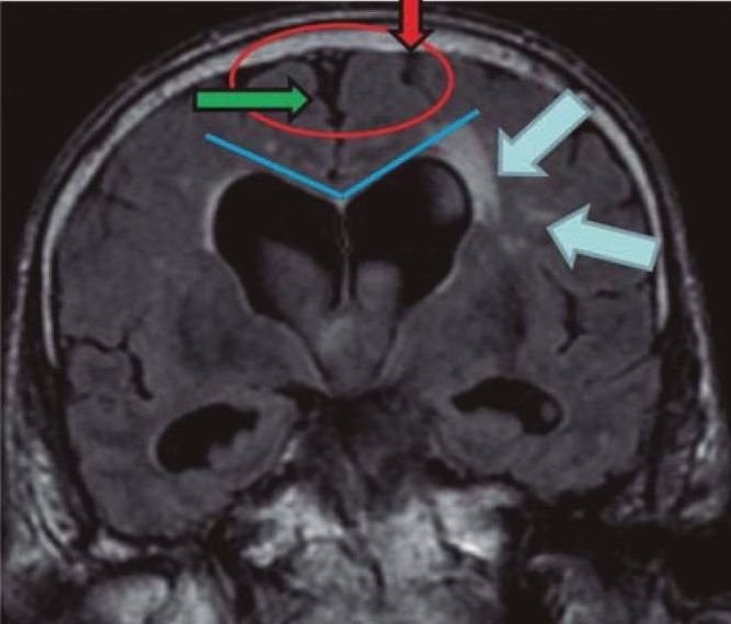 How Neuroradiology Contributes to Treating Hydrocephalus