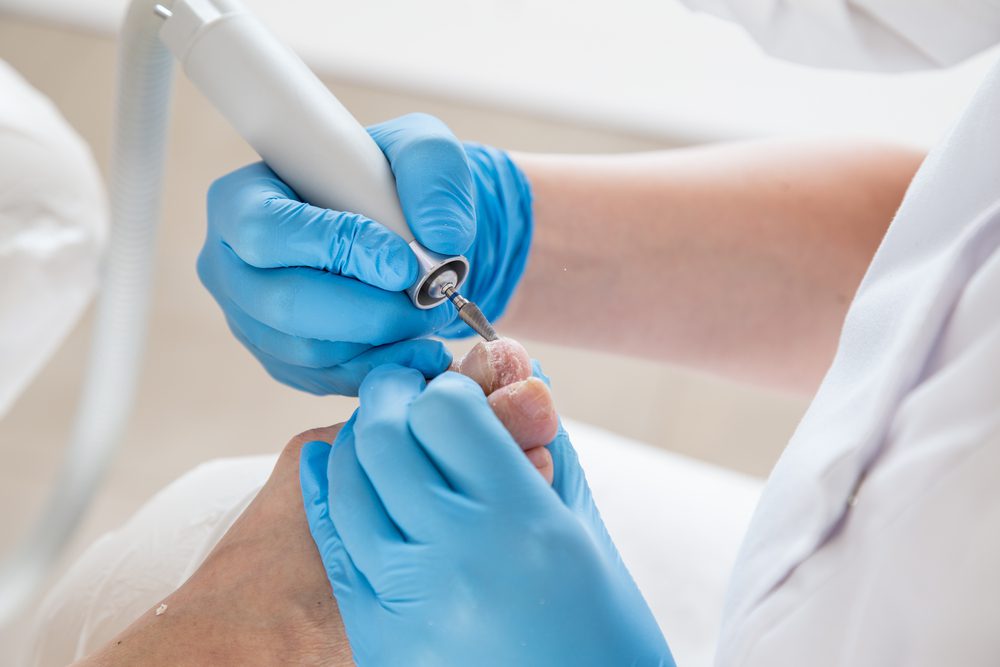 Preventing Fungal Nail Infections