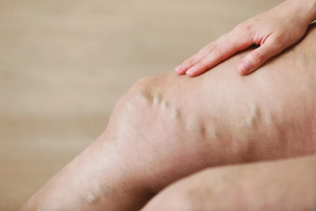 The Benefits of Cosmetic Vein Treatment for Enhancing Appearance