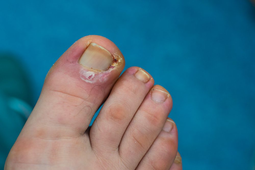 Tips and Tricks for Managing Ingrown Toenails