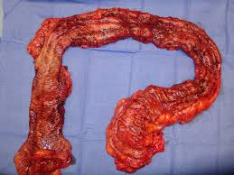 What Is Ulcerative Colitis and How Do GI Doctors Treat It?