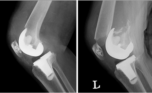 What To Expect From Total Joint Replacement Surgery