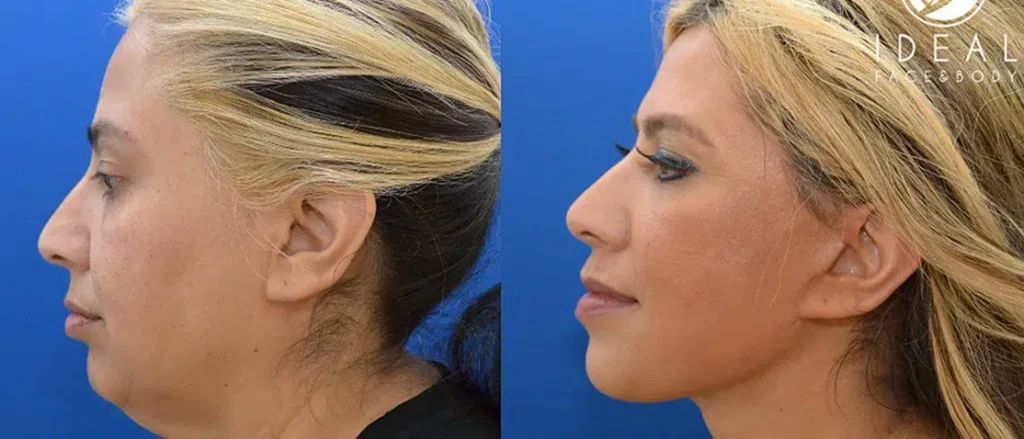 What To Know About Facelift Surgery