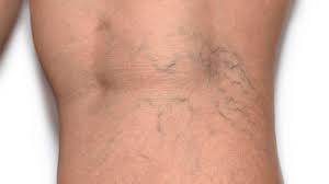 Common Causes and Treatments for Spider Veins