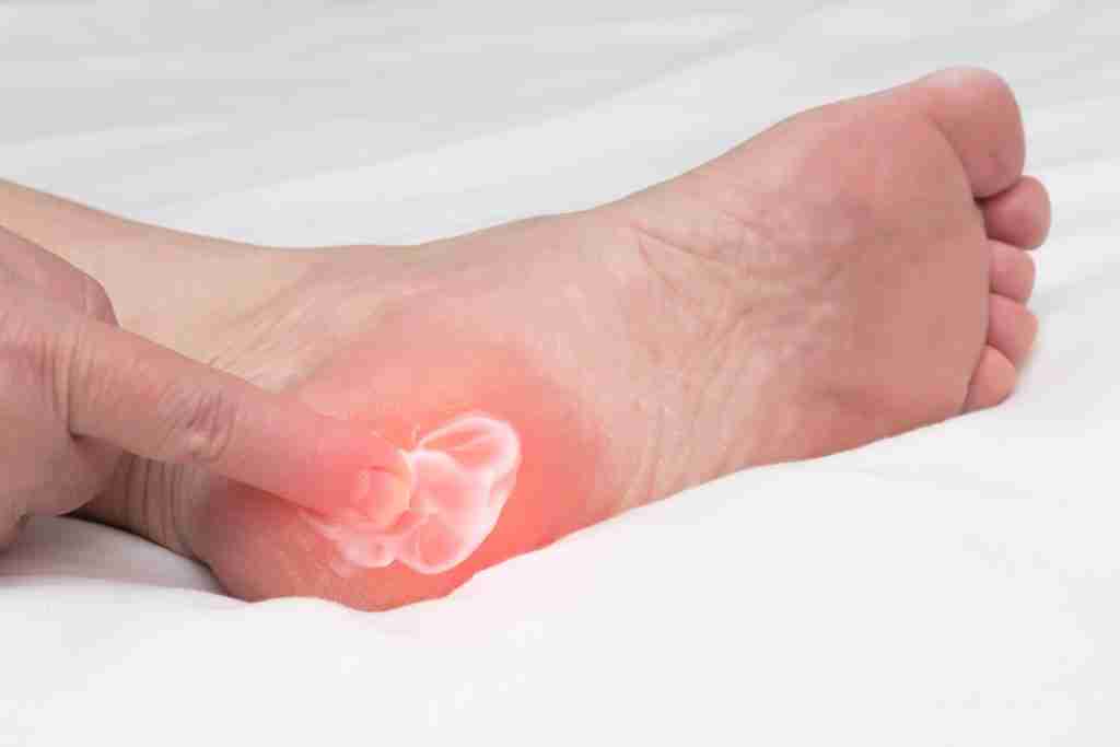 Exercises and Stretches to Alleviate Plantar Fasciitis Pain