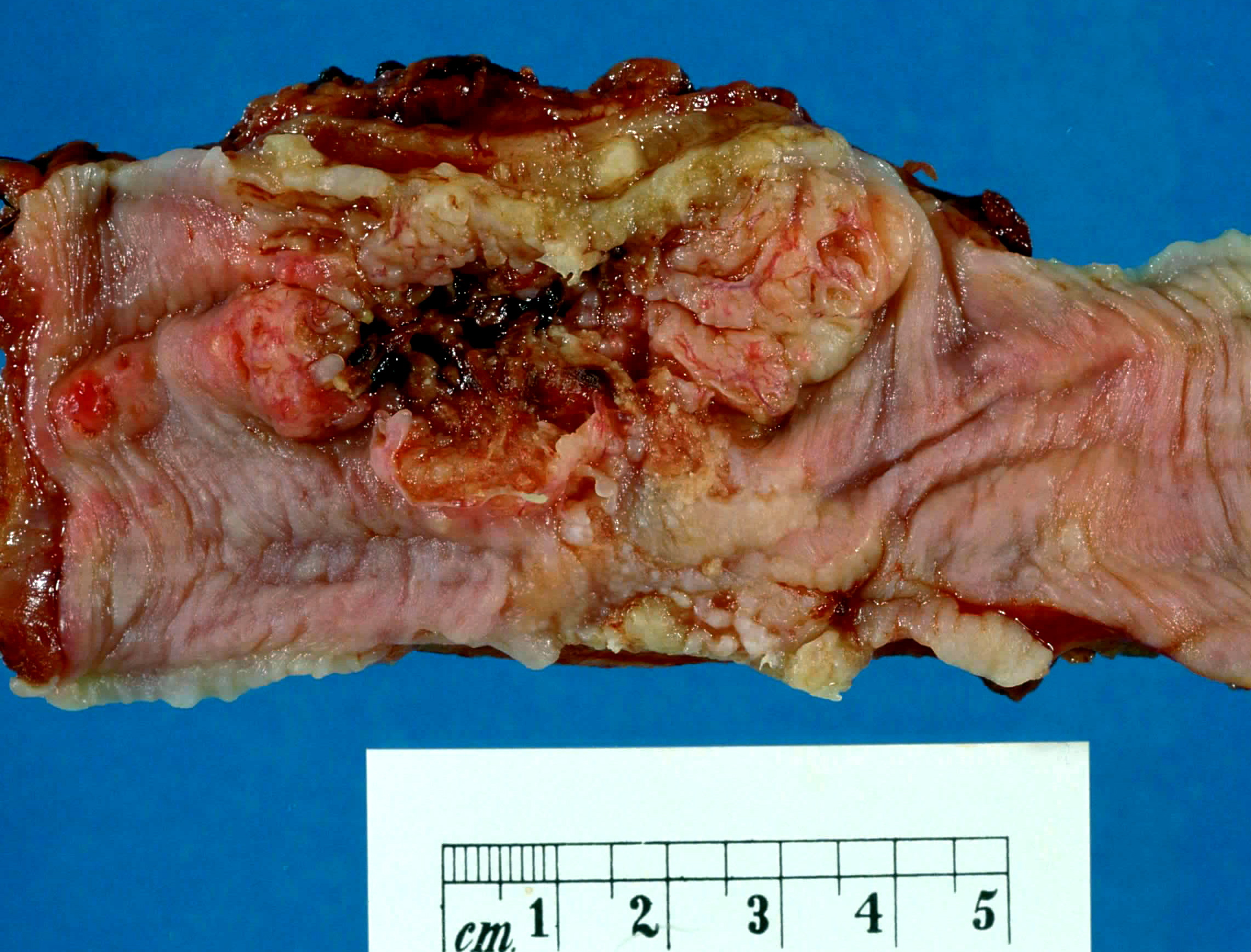 Oncology Treatment Options for Gastrointestinal Cancer