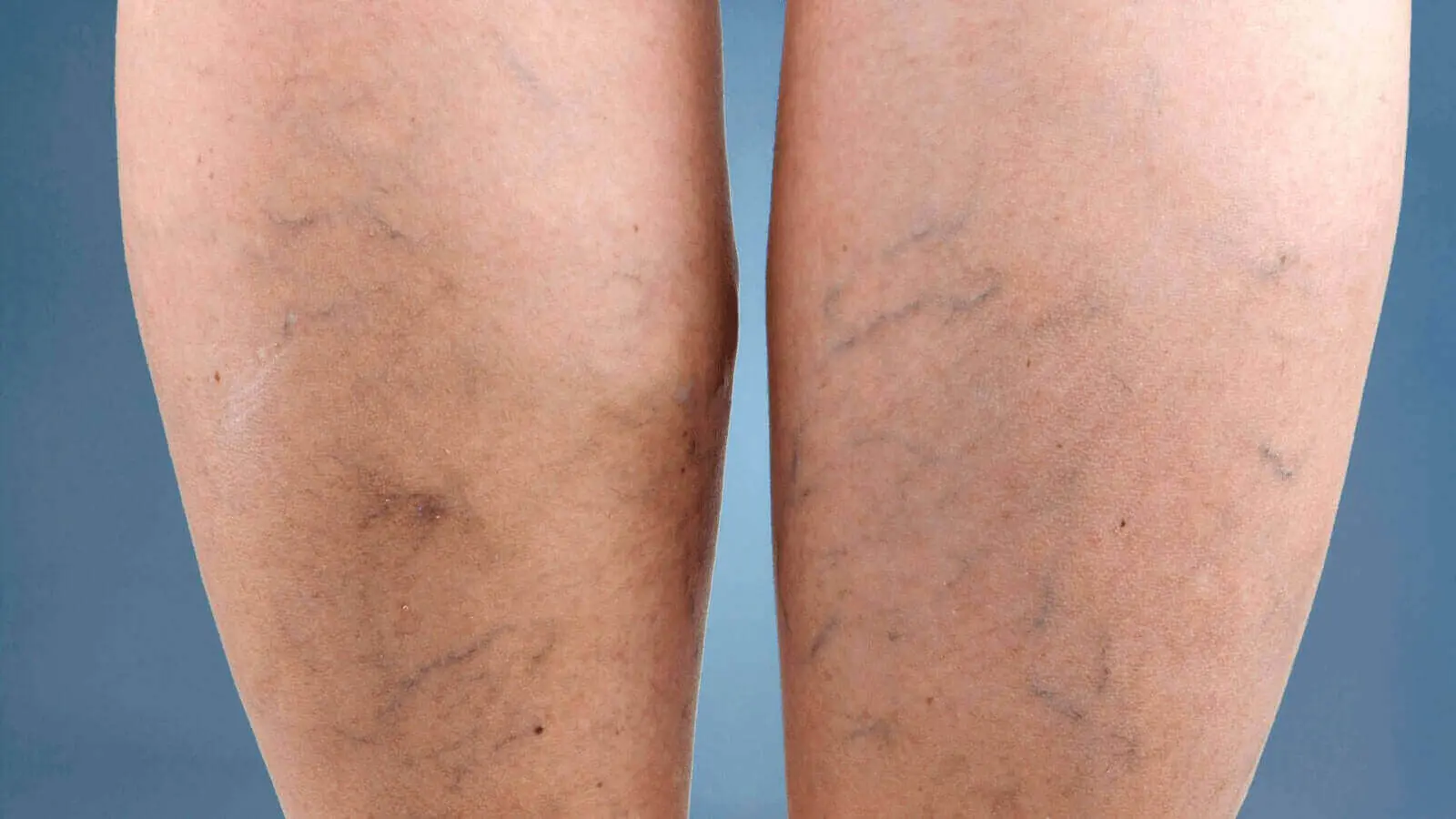 The Causes and Treatments for Varicose Veins