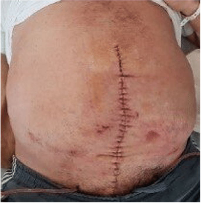 What To Expect During a Hernia Repair Procedure