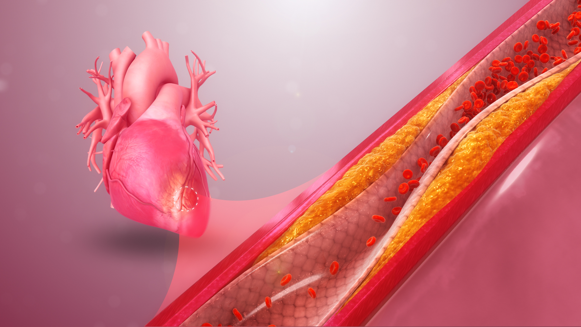 Exploring the Link Between Coronary Artery Disease and Other Heart Conditions