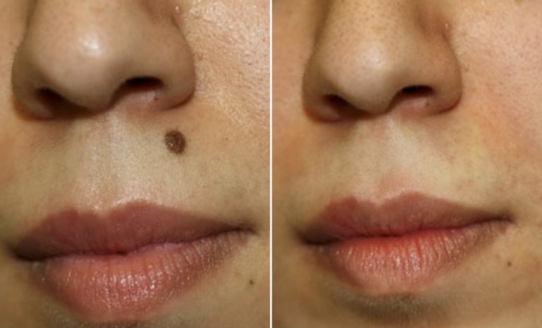 Skin Tag Removal: When to Seek Professional Help