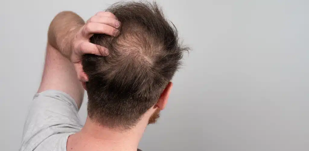 The Impact of Hair Loss and the Benefits of Transplants