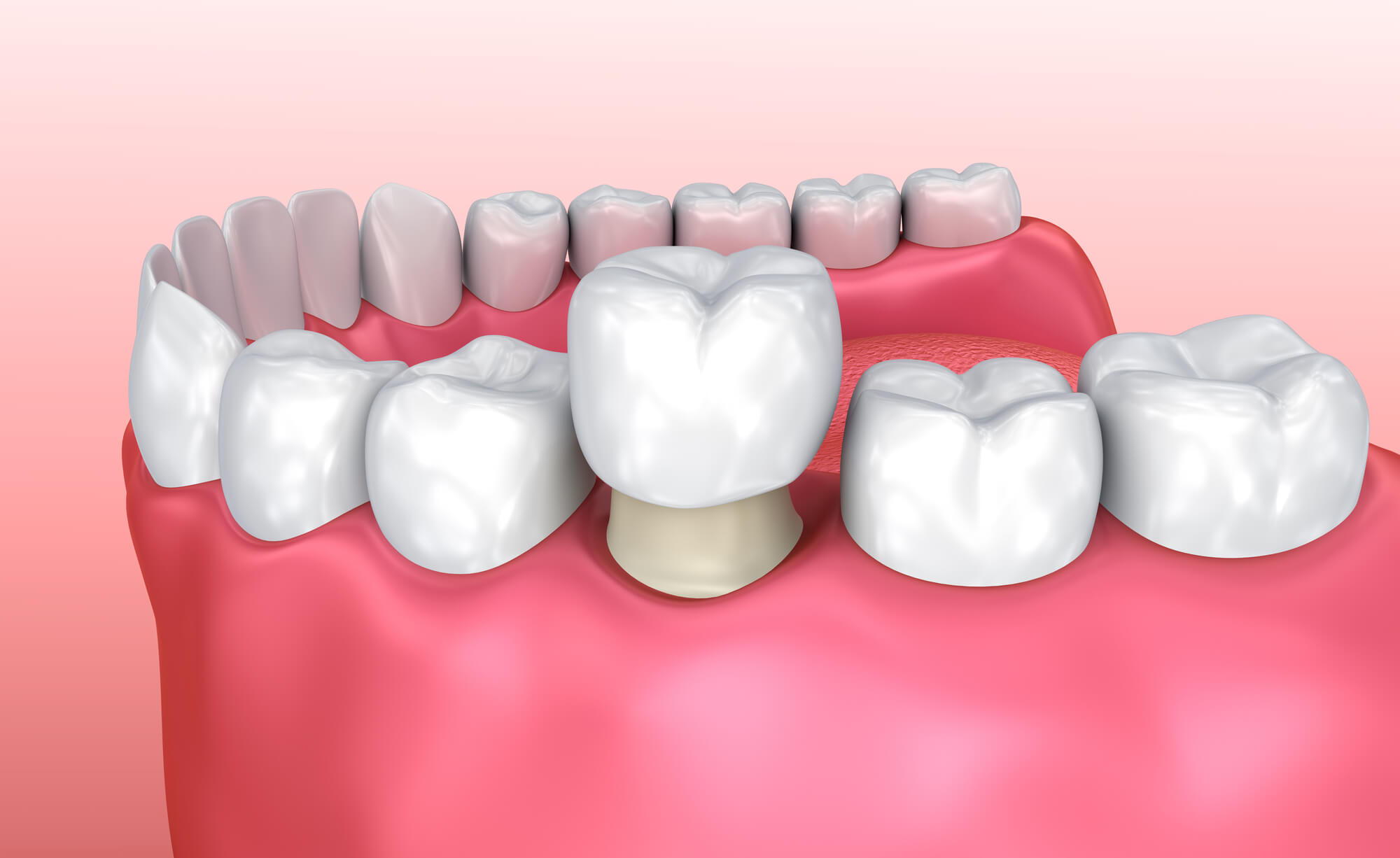 What to Expect During Your Dental Crown Procedure