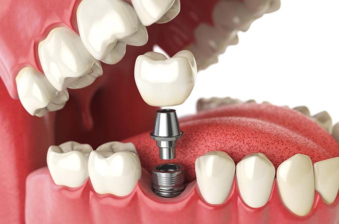 3 Benefits of Dental Implants