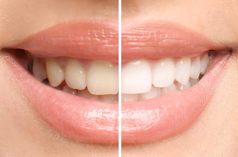 At-home vs. Professional Teeth Whitening