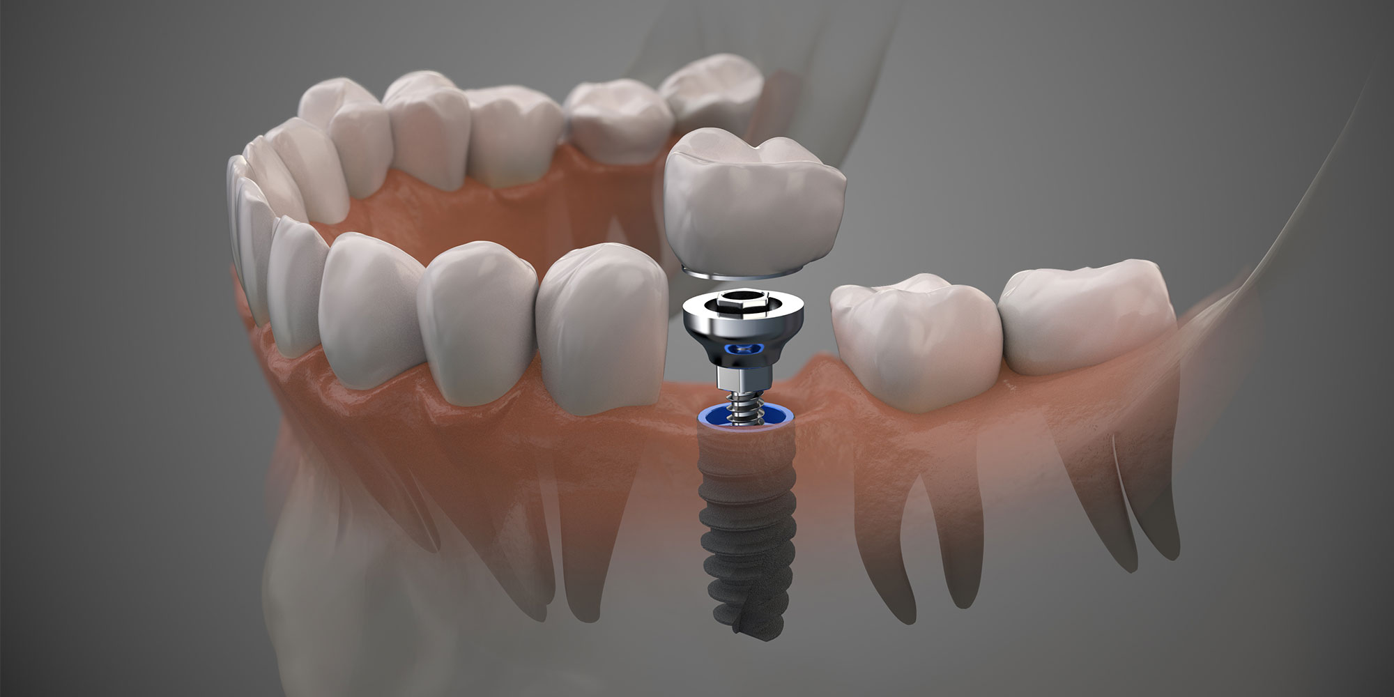FAQs About Dental Implants