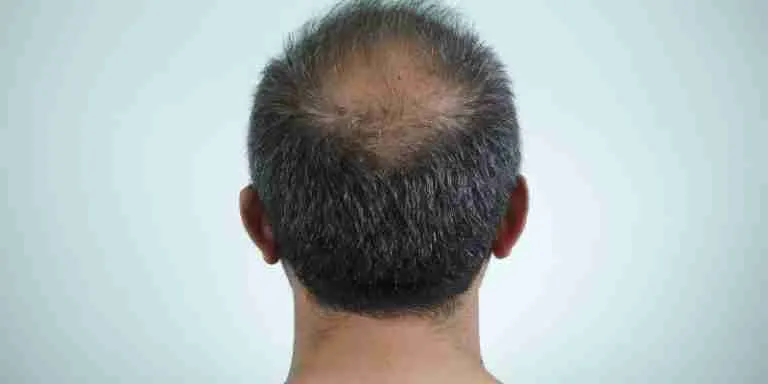 Tips and Strategies for Managing Hair Loss